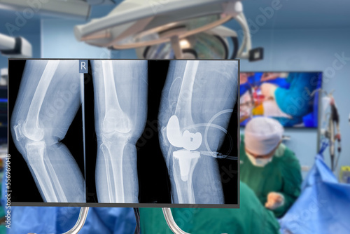 x-ray of  knee. Blurry Traumatology orthopedic surgery hospital operating room for the Total Knee Replacement operation. Medical health and Education concept.