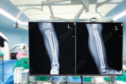 x-ray of legs. Blurry Traumatology orthopedic surgery hospital operating room for the legs operation. Medical health and Education concept.