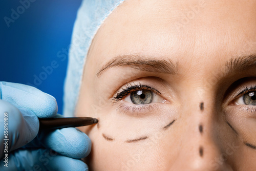 surgeon preparing woman's face for plastic surgery. facelift procedure photo