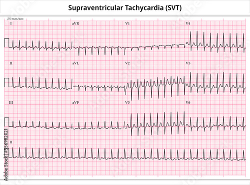 ECG Supraventricular Tachycardia - 12 Leads ECG Paper