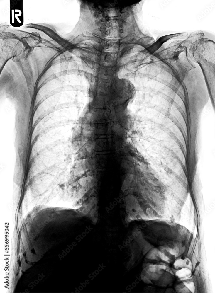 Film chest xray show alveolar infiltrate at left middle lung Stock