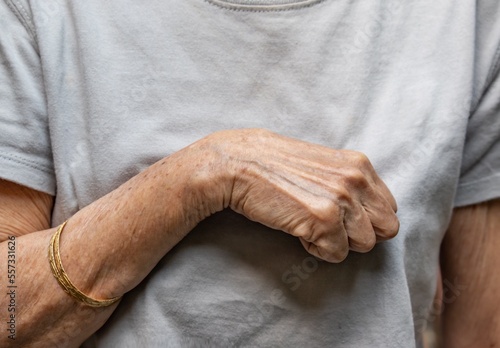Volkmann contracture in left upper limb of Southeast Asianold  woman. It is a permanent shortening of forearm muscles that gives rise to a clawlike posture of the hand, fingers, and wrist.