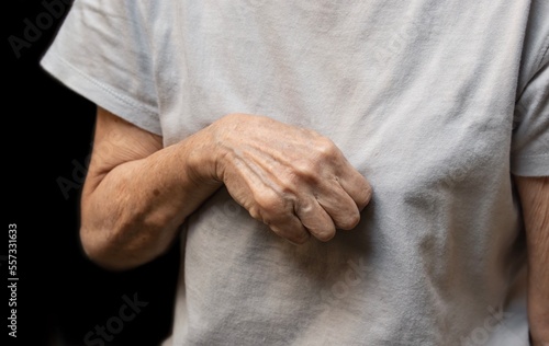 Fotografía Volkmann contracture in left upper limb of Southeast Asian old woman