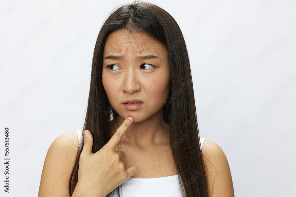 Asian woman facial skin problems, acne and inflammation, red rashes and allergies, chicken pox, sadness from rashes. Facial skin care concept for diseases and nerves Asian woman facial skin problems, acne and inflammation, red rashes and allergies, chicken pox, sadness from rashes. Facial skin care concept for diseases and nerves