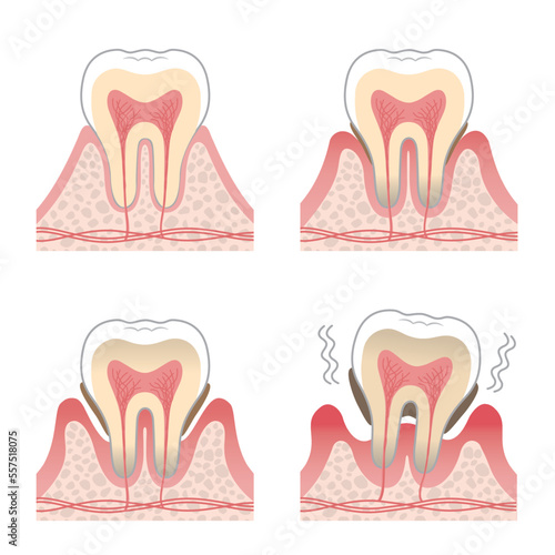 歯のイラスト_歯周病の進行