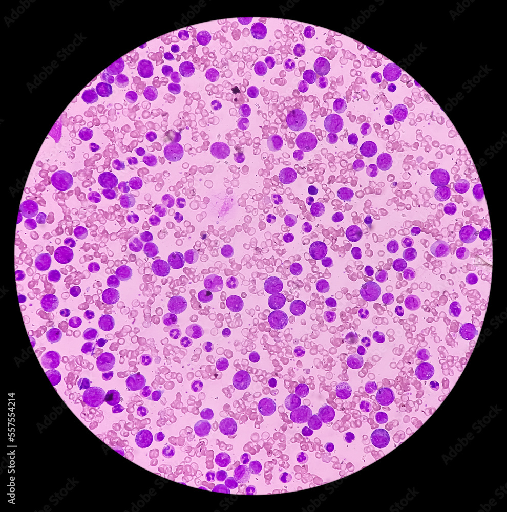Chronic myeloid leukemia or CML(chronic phase) with microcytic ...