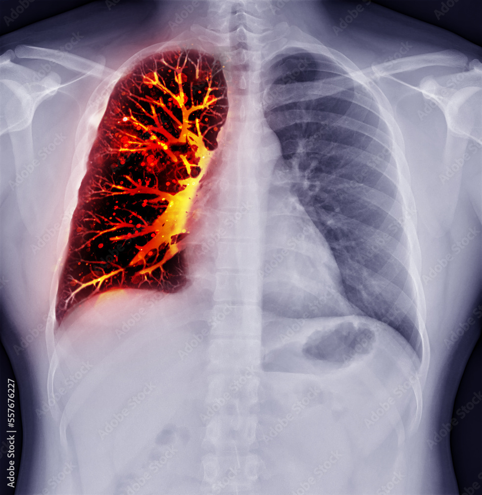 Fusion image of Chest xray and CT Chest Coronal view for lung