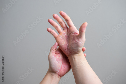 汗疱　手荒れ　多汗症のイメージ