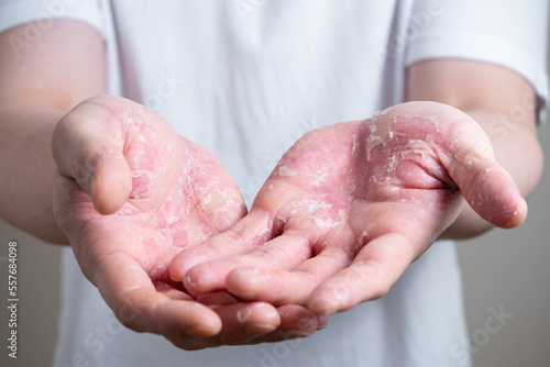 汗疱　手荒れ　多汗症のイメージ