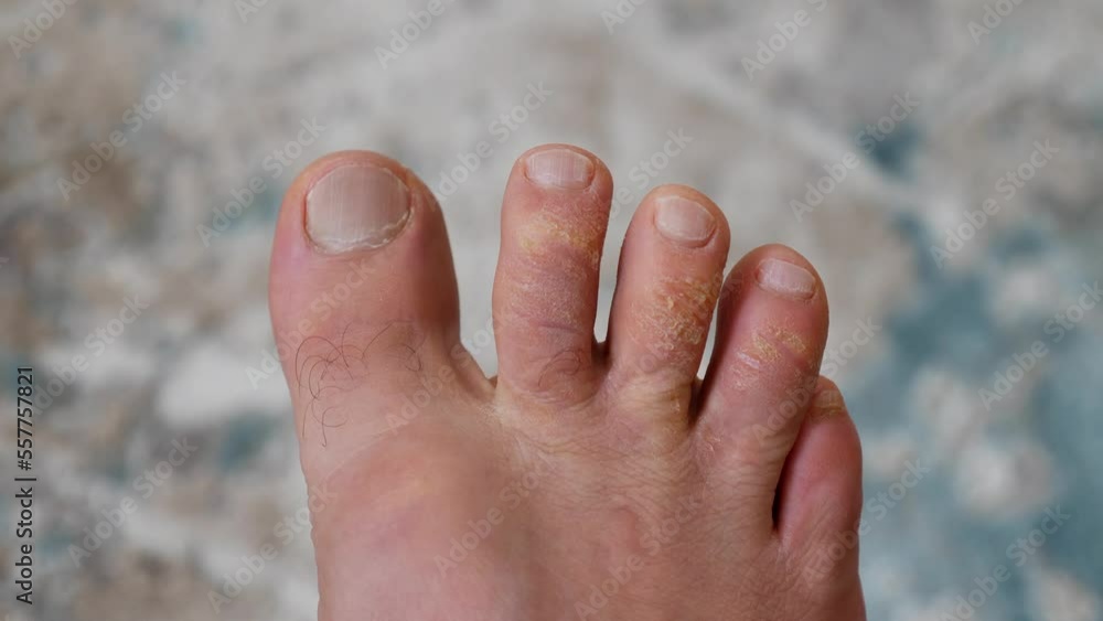 calluses and fungus on the toes, foot fungal diseases, itchy foot