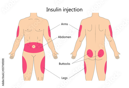 Insulin injection infographic vector. Diabetes treatment and insulin shots area on human body. Buttocks, upper outer arms and abdomen places. photo