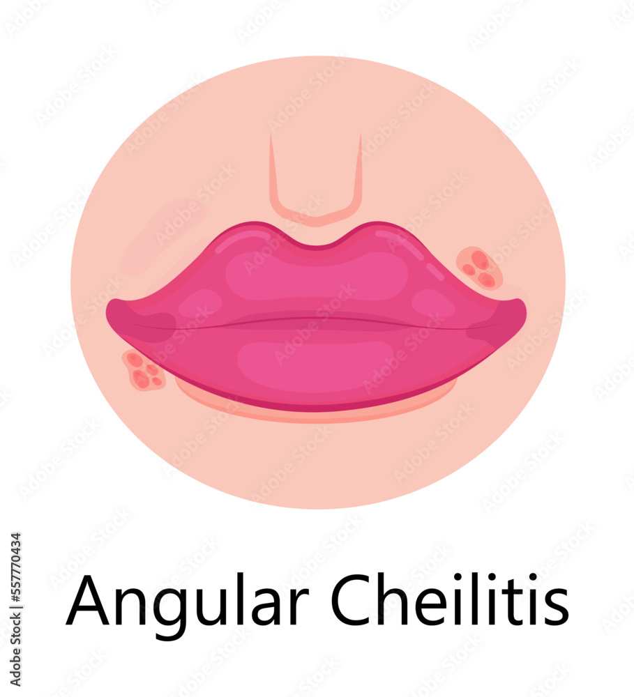 Herpes lips vector. Simplex virus infection causes recurring episodes of small, painful, fluid-filled blisters on skin, mouth, lips. Herpes lips vector. Simplex virus infection causes recurring episodes of small, painful, fluid-filled blisters on skin, mouth, lips.