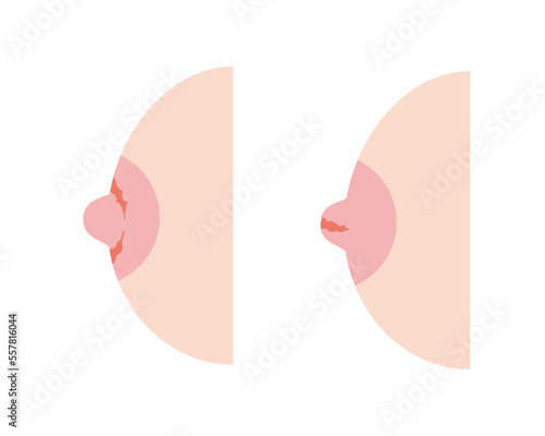 乳首亀裂が起こった女性の胸