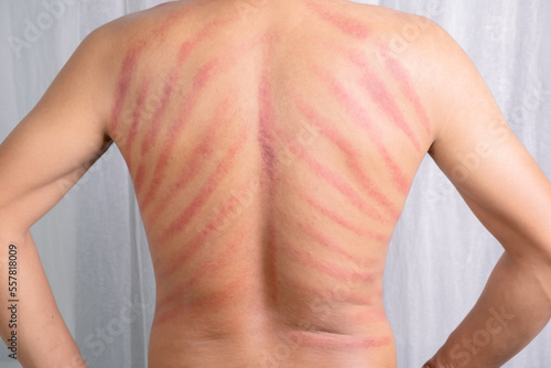 Photo The red mark on the man's back was caused by Gua Sha