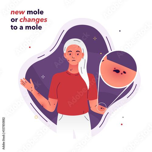 Vector illustration of a girl with moles all over her body. Changes in a mole are symptoms of a hormonal imbalance, an infection in the body.