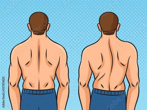 Man back with scoliosis pinup pop art retro raster illustration. Comic book style imitation.