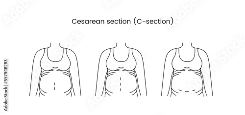 Caesarean section views icon line in vector, illustration of a pregnant woman.