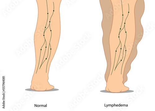 Lymphedema illustration compared to a normal leg 