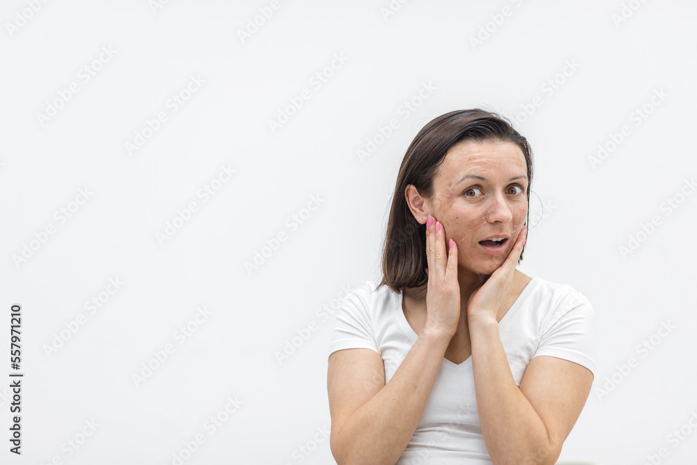 Photo of woman having skin problems and feeling bad because of it. Photo of woman having skin problems and feeling bad because of it.