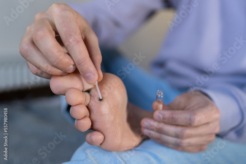 Alternative home treatment of verruca foot. Man applying liquid celandine extract on the wart plantar of his foot. Human papilloma callus virus or HPV, viral skin infection concept.  photo