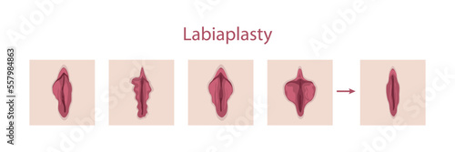 Labiaplasty photo
