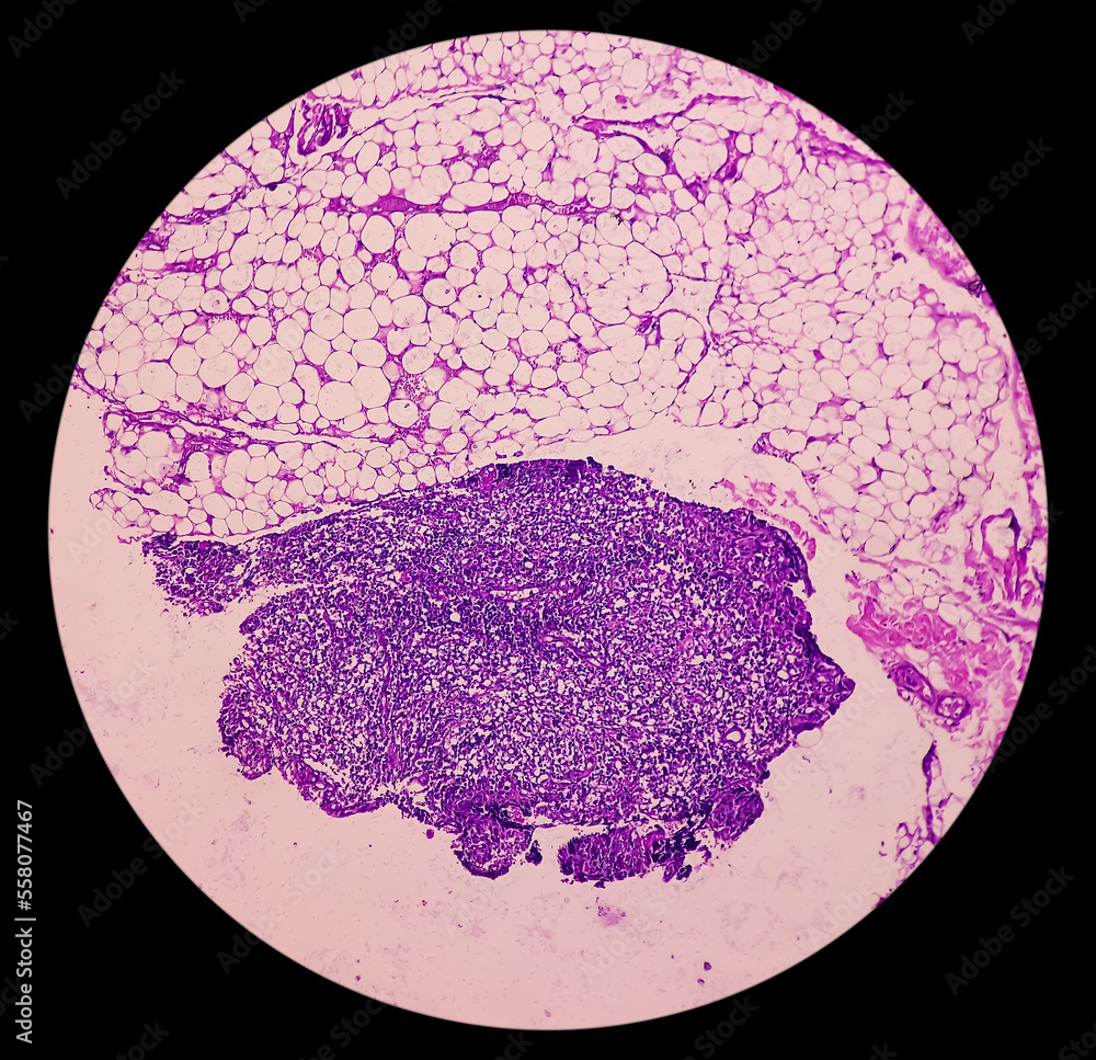 Foto de Lymph node (biopsy) Hodgkin's lymphoma, mixed cellularity