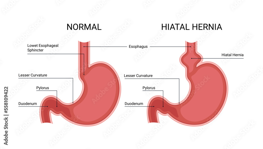 Healthy stomach and hiatal hernia infographic - obrazy, fototapety, plakaty 