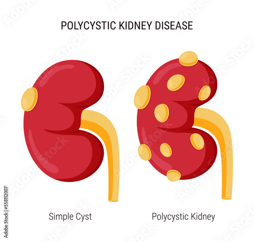 Polycystic kidney disease, simple cyst and polycystic kidney vector design
