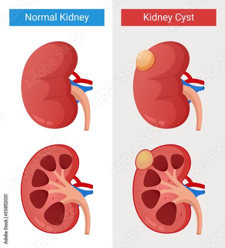 Kidney disease, normal kidney and cyst kidney design illustration
