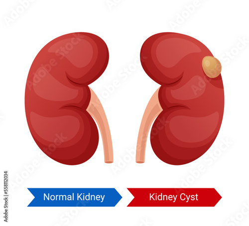 Illustration of normal kidney and kidney cyst design