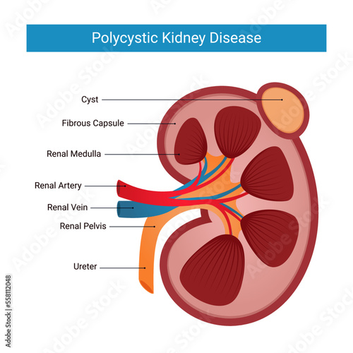 Polycystic kidney disease infographic