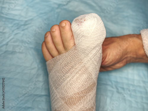 Vászonkép Covering with medicine bandage injury foot with hurt big toe
