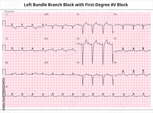 ECG First-Degree AV Block with LBBB (Left Bundle Branch Block) - 12 Leads ECG Paper - Vector - Medical Illustration