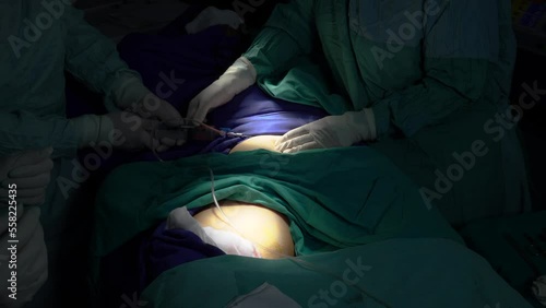 A middle-aged woman who had stem cells removed from her abdomen and legs during plastic surgery.