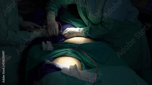 A middle-aged woman who had stem cells removed from her abdomen and legs during plastic surgery.