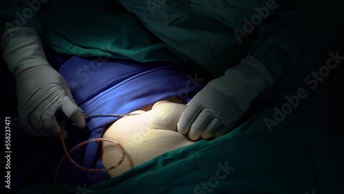 A middle-aged woman who had stem cells removed from her abdomen and legs during plastic surgery.