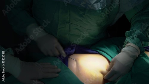A middle-aged woman who had stem cells removed from her abdomen and legs during plastic surgery.