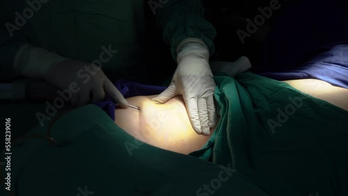 A middle-aged woman who had stem cells removed from her abdomen and legs during plastic surgery.