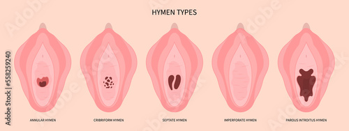 Anatomy of hymen before Hymenoplasty surgery for repair the procedure in medical photo