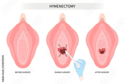 Surgery procedure in medical and types of hymen for hymenoplasty repair