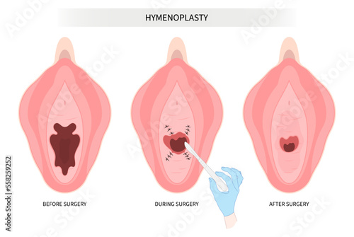 Hymenoplasty surgery for hymen repair the procedure in medical photo