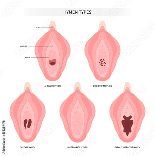 Types of hymen and hymenoplasty surgery for repair the procedure in medical