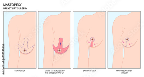 Enlarged correct breast surgery silicone implantation small size droop pain women shape fat transfer lift asymmetrical nipple sag rejuvenate skin scar