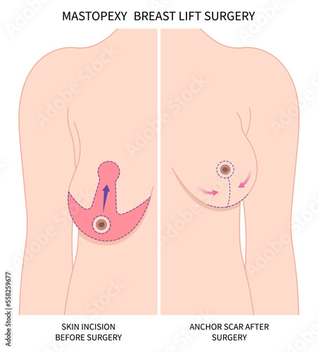 Breast surgery implantation small size droop pain silicone women shape fat transfer lift asymmetrical nipple sag rejuvenate skin scar enlarged correct