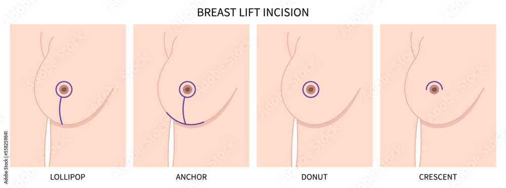 Breast surgery implantation small size droop pain silicone women shape fat  transfer lift asymmetrical nipple sag rejuvenate skin scar enlarged correct  Stock Vector