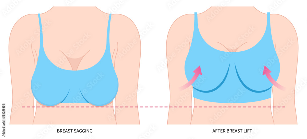 Vetor de Enlarged correct breast surgery silicone implantation small size  droop pain women shape fat transfer lift asymmetrical nipple sag rejuvenate  skin scar do Stock