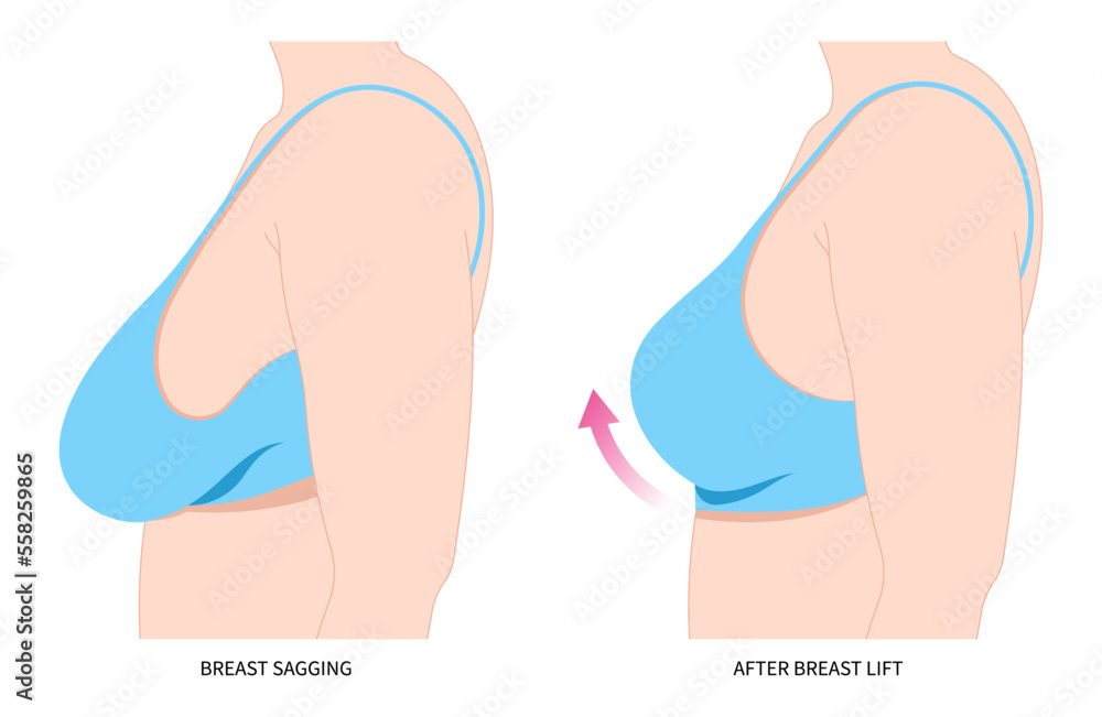 Breast fat transfer lift asymmetrical nipple sag rejuvenate surgery  implantation small size droop pain silicone women shape skin scar enlarged  correct Stock Vector