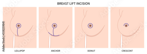 Asymmetrical women breast shape lift nipple silicone surgery implantation small size droop pain fat transfer sag rejuvenate skin scar enlarged correct