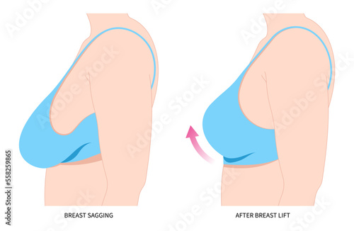 Breast fat transfer lift asymmetrical nipple sag rejuvenate surgery implantation small size droop pain silicone women shape skin scar enlarged correct