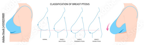 Sag rejuvenate of breast surgery implantation small size droop pain silicone women shape fat transfer lift asymmetrical nipple skin scar enlarged correct